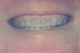 teeth1