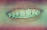 teeth2