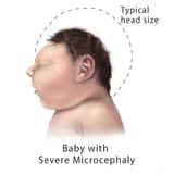 cdc-severe-microcephaly[1]