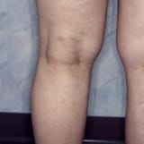 vein-treatment-2-after-photo_0