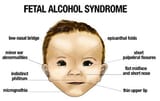 Fetal+alcohol+syndrome