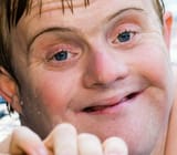trisomy21b