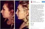 laura-loomer-nose-job8