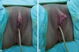 Preoperative-appearance-Clitoris-is-enlarged-after-hormonal-treatment-Ventral-view