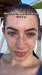 freckles_thumb.jpg