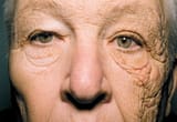 sun damage