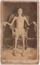 emaciatedunionsoldierpicture