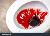 stock-photo-splattered-blood-in-a-toilet-bowl-representing-a-bloody-stool-a-sign-of-dangerous-medical-issues-493577998