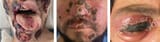 monkeypox