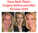 Dana Bash plastic surgery