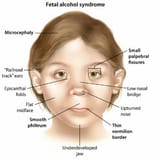 fetal-alcohol-spectrum-disorder