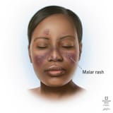 23163-lupus-rash