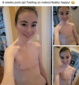 ftm zipper tits