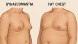 Gynaecomastia-vs.-Fat-Chest