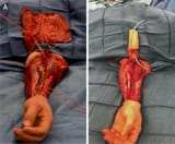 flayed