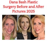 Dana Bash plastic surgery