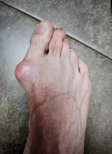 bunion