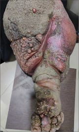 lymphedema1