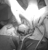 postsurgicalabortion333