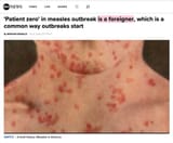 patient zero measles