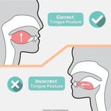 Correct-vs-Wrong-Tongue-Posture-300x300