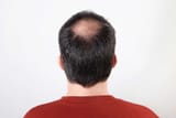 alopecia-areata-5_1500x