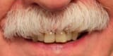 boltontache