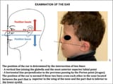 Clinical-examination-of-the-ears-a-normal-position-of-the-ear-b-patient-presenting-a