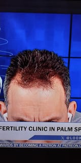 hair plugs