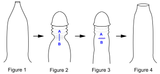 Preputioplasty