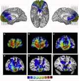 Lesion-overlap-of-vmPFC-patients-Lesions-of-the-vmPFC-patients-displayed-in-mesial-and