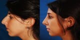 How-To-Get-A-Nose-Job-Covered-By-Insurance