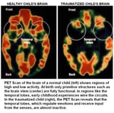 jews part of the point of circumcision is intentional frontal cortex damage.