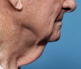eppley-male-direct-necklift-before