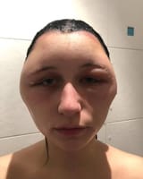 a-young-womans-head-after-an-allergic-reaction-to-a-home-v0-ex960iciww8f1[1]