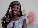 Albino African child and mother