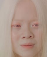 Albino Asian girl