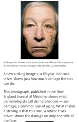 sun_damage