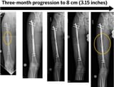 manlet_therapy_x-ray_