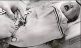 circumcision