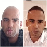 Norwood-6-hair-transplant-before-and-after-4500-graft