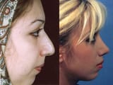 Interesting_Before_and_After_Nose_Surgery_10