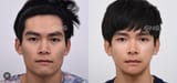 korean_man_jaw _reduction_-_Ricerca_Google