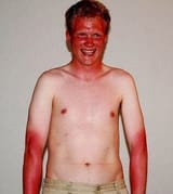 2257-pretty-bad-sunburn