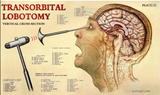 lobotomy