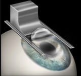 LASIK