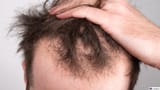signs-of-balding
