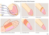 Circumcision foreskin removal