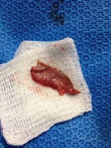 amputated foreskin