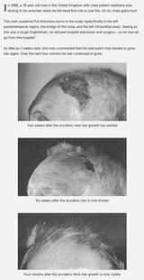 screencapture-anagengrowth-scalp-burn-hair-loss-reversal-2025-07-05-11_39_58